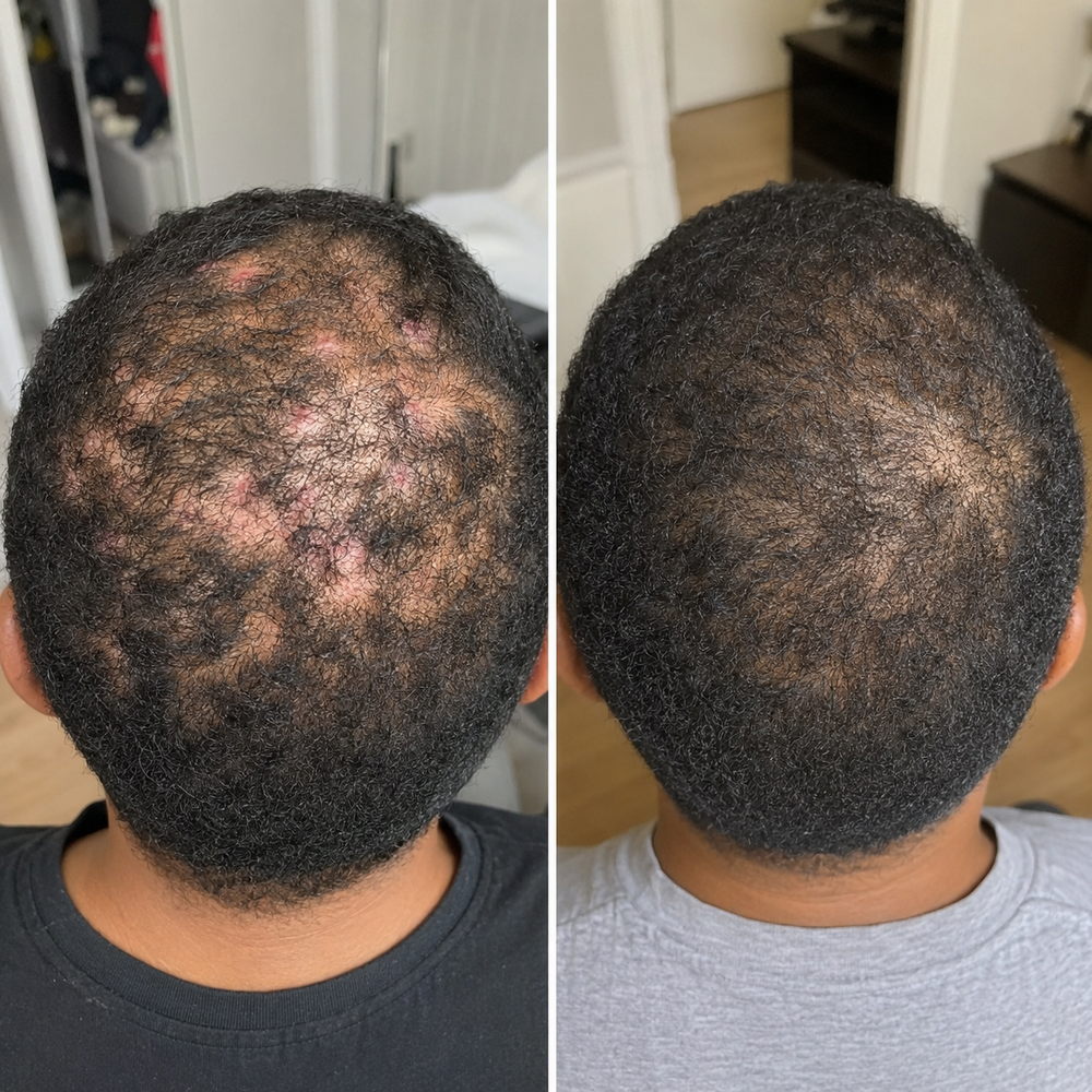 4. Red Light Has Real Clinical Evidence Behind Hair Growth Support — Especially in the Spots Where Bumps Keep Returning